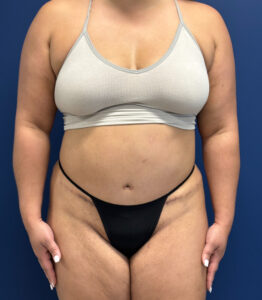 Abdominoplasty-Case--9870 | After Tummy Tuck 1