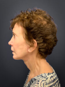 Facial-Fat-Grafting-Case--5079 | After Facial Fat Grafting 2