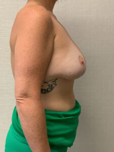 Augmentation-Mastopexy-Case--6355 | After Breast Augmentation With Lift 2