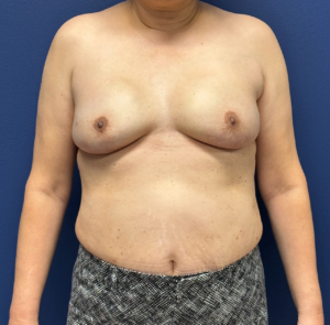 Breast-Reconstruction-Case--28751 | After Dr. Samir Rao 1