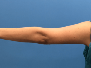 Brachioplasty-Case--276 | After Arm Lift 1