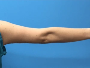 Brachioplasty-Case--276 | After Body 2