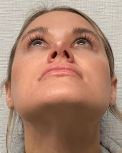 Rhinoplasty-Case--23703 | After Face 2
