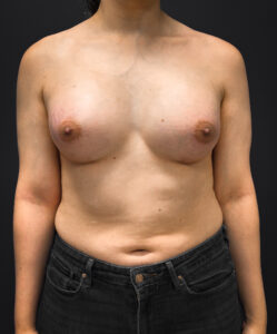 Front profile of patient after undergoing breast augmentation surgery