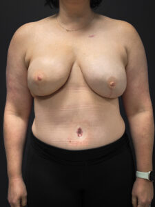 Front profile of patient after undergoing DIEP Flap surgery