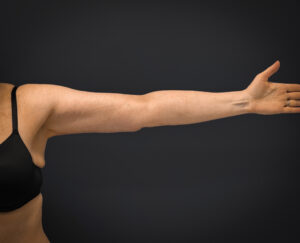 Brachioplasty-Case--3119 | After Arm Lift 2