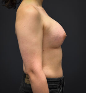 Right profile of patient after undergoing breast augmentation surgery