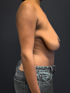 Right profile of patient before undergoing breast reduction surgery