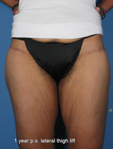 Thigh-lift-Case--75 | After Thigh Lift 1