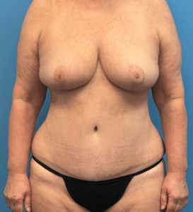 Mommy-Makeover-Case--27387 | After Mommy Makeover 1