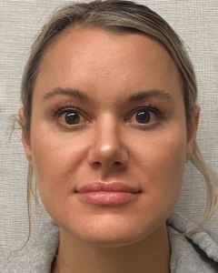 Rhinoplasty-Case--23703 | After Face 1