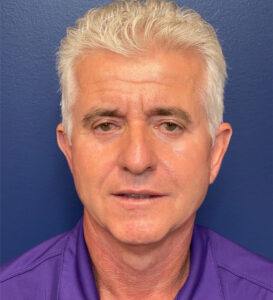 Facelift-Blepharoplasty-Case--291 | After Facelift for Men 1