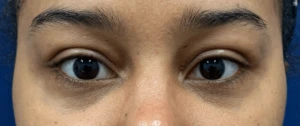 Lower-Blepharoplasty-Case--28049 | After Face 1