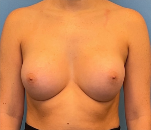 Breast-Augmentation-Case--224 | After Breast Augmentation 1