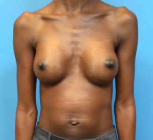 Case--97 | After Breast Augmentation 1