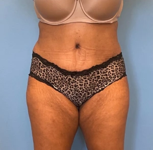 Lipoabdominoplasty-Case--255 | After Body 1