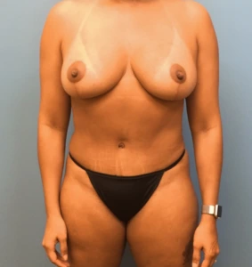 Mommy-Makeover-Case--40 | After Body 1