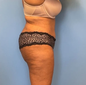 Lipoabdominoplasty-Case--255 | After Body 2