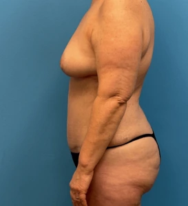 Mommy-Makeover-Case--27387 | After Body 2