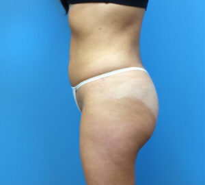 Brazilian-Butt-Lift-Case--265 | After Brazilian Butt Lift 1