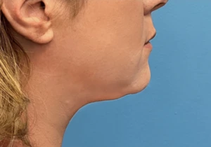 Case--20811 | After Face 2