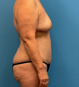 Lipoabdominoplasty-Case--24903 | After Body 2