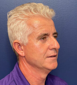 Facelift-Blepharoplasty-Case--291 | After Facelift for Men 2