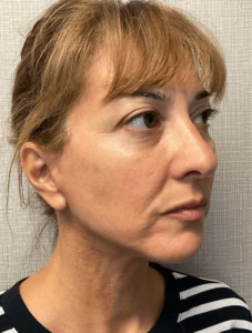 Case--20575 | After Face 2