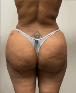 Brazilian-Butt-Lift-Case--7979 | After Brazilian Butt Lift 1
