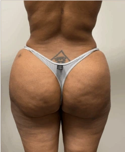 Brazilian-Butt-Lift-Case--7979 | After Body 1