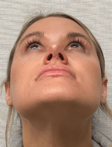 Rhinoplasty-Case--4972 | After Dr. Arjun Kanuri 2