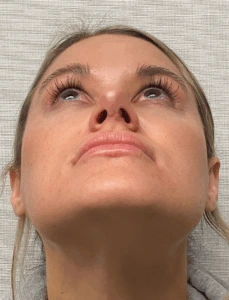 Rhinoplasty-Case--4972 | After Face 2