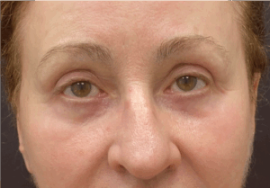 Blepharoplasty-Case--9685 | After Eyelid Surgery 1