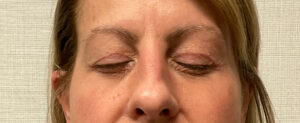 Upper-Blepharoplasty-Case--7202 | Before Eyelid Surgery 2