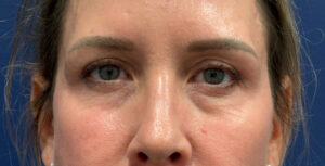 Blepharoplasty-Case--8003 | After Dr. Arjun Kanuri 1