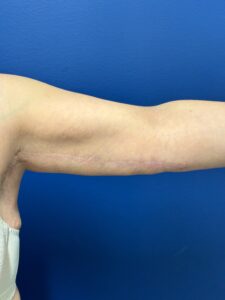 Brachioplasty-Case--1162 | After Arm Lift 1