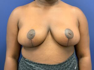 Breast-Reduction-Case--7783 | After Breast Reduction 1
