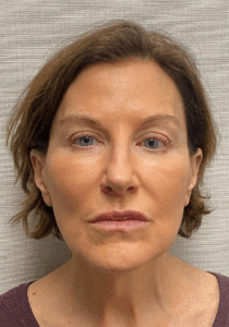 Facelift-Case--6591 | After Facelift 1