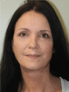 Face-and-Neck-Lift-Case--9403 | After Face 1