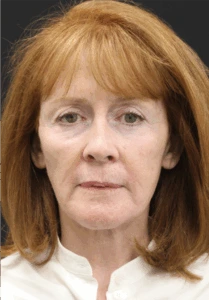 Facelift-Case--1951 | After Face 1