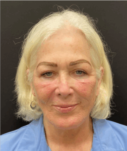 Face-and-Neck-Case--1975 | After Neck Lift 1