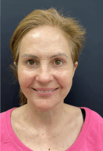 Necklift-Case--4836 | After Neck Lift 1