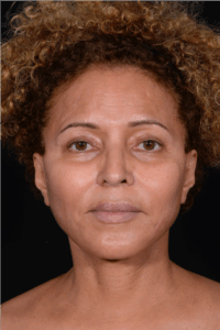 Face-and-Neck-Lift-Case--3772 | After Neck Lift 1