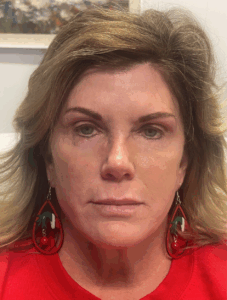 Facelift-Case--8163 | After Face360 1