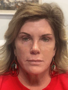 Facelift-Case--8163 | After Face 1