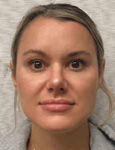 Rhinoplasty-Case--4972 | After Face 1