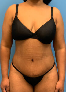 Abdominoplasty-Case--1110 | After Tummy Tuck 1