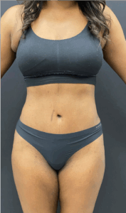 Abdominoplasty-Case--6650 | After Liposuction 1