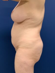 Breast-Reduction-Case--2878 | After Breast Reduction 2