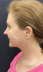 Necklift-Case--4836 | After Face 2